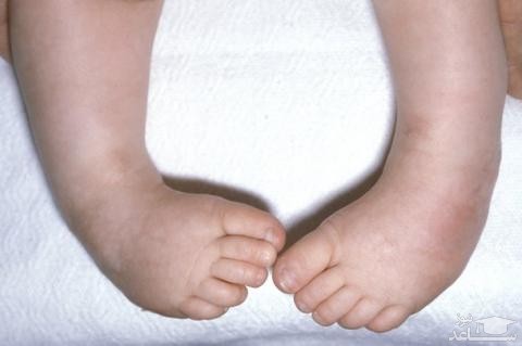 علل پاچنبری در کودکان و راههای درمان آن