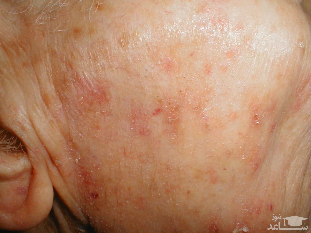 میزان، تاثیرات و مکانیزم اثر آمینولوولینیک اسید