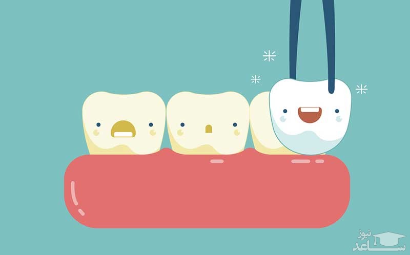 در مورد خارج کردن روکش دندان چیست؟