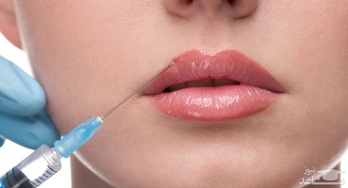 حقایقی در مورد تزریق ژل لب