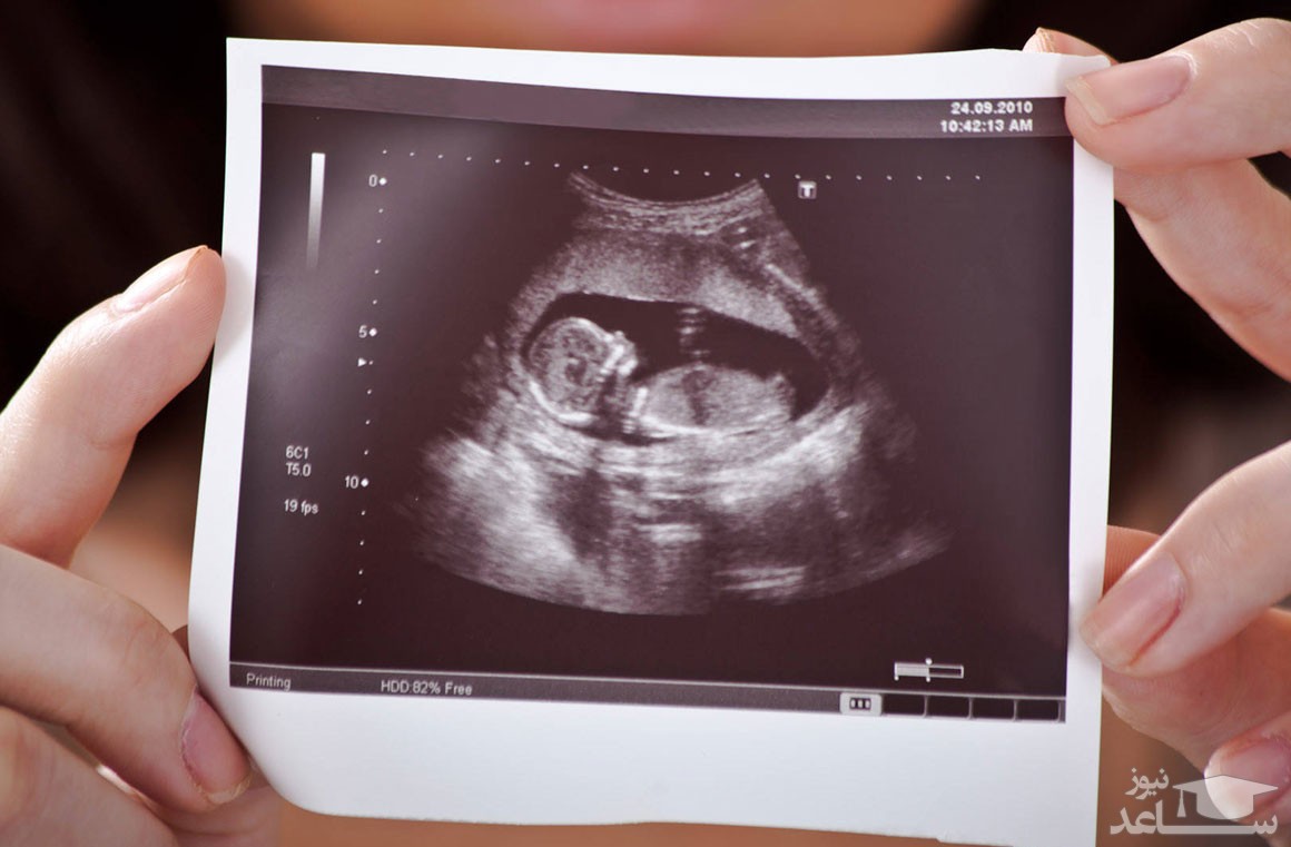 همه چیز درباره سونوگرافی تعیین جنسیت جنین