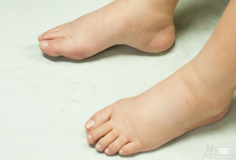 دلایل ورم کردن پاها در دوران حاملگی