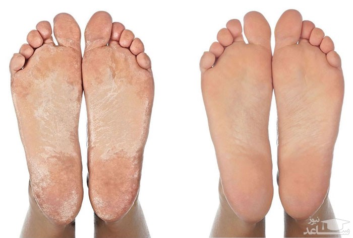درمان خانگی برای پینه های پا