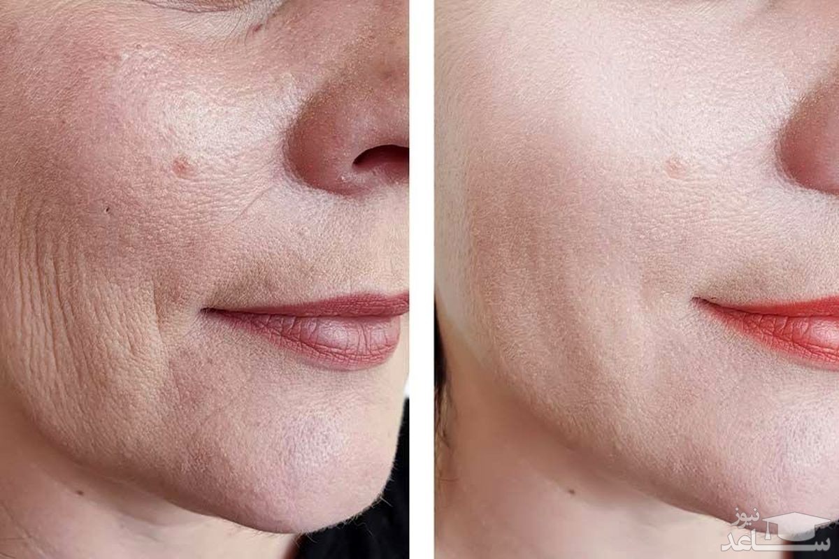 تاثیر ژل پروفایلو پوست چروک و پوست صاف