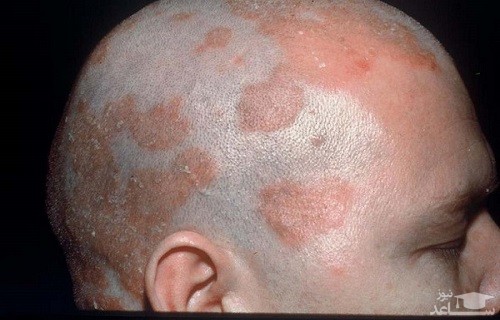 علائم بیماری درماتیت سبورئیک و راههای درمان آن