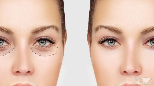 نکاتی درباره جراحی زیبایی پلک