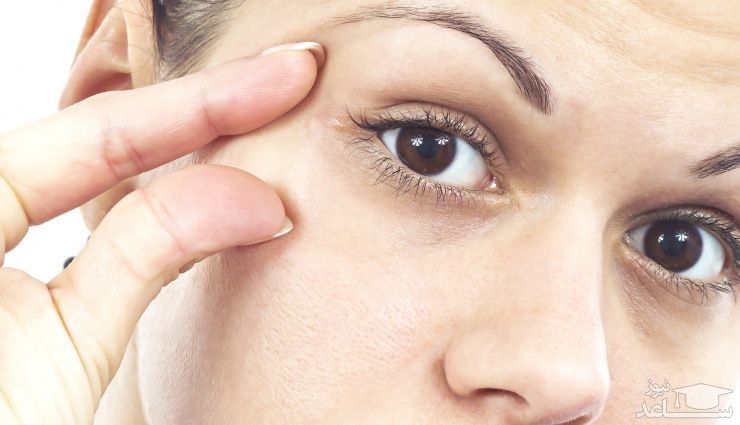 درمان های خانگی برای از بین بردن پرش پلک چشم