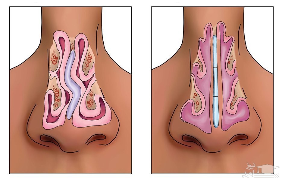 سپتوپلاستی چیست؟