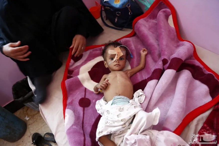 نوزاد یمنی دچار سوء تغذیه در بیمارستانی در شهر صنعا/ خبرگزاری آناتولی