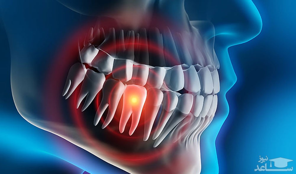 سوالات متداول در مورد عفونت دندان