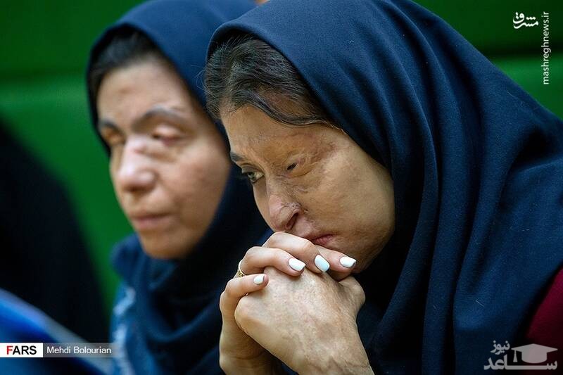 (عکس)  قربانیان اسیدپاشی در مجلس شورای اسلامی