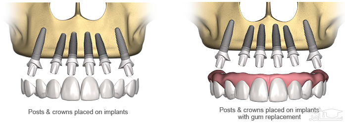 مزایای روانی دندان مصنوعی بر پایه 6 ایمپلنت