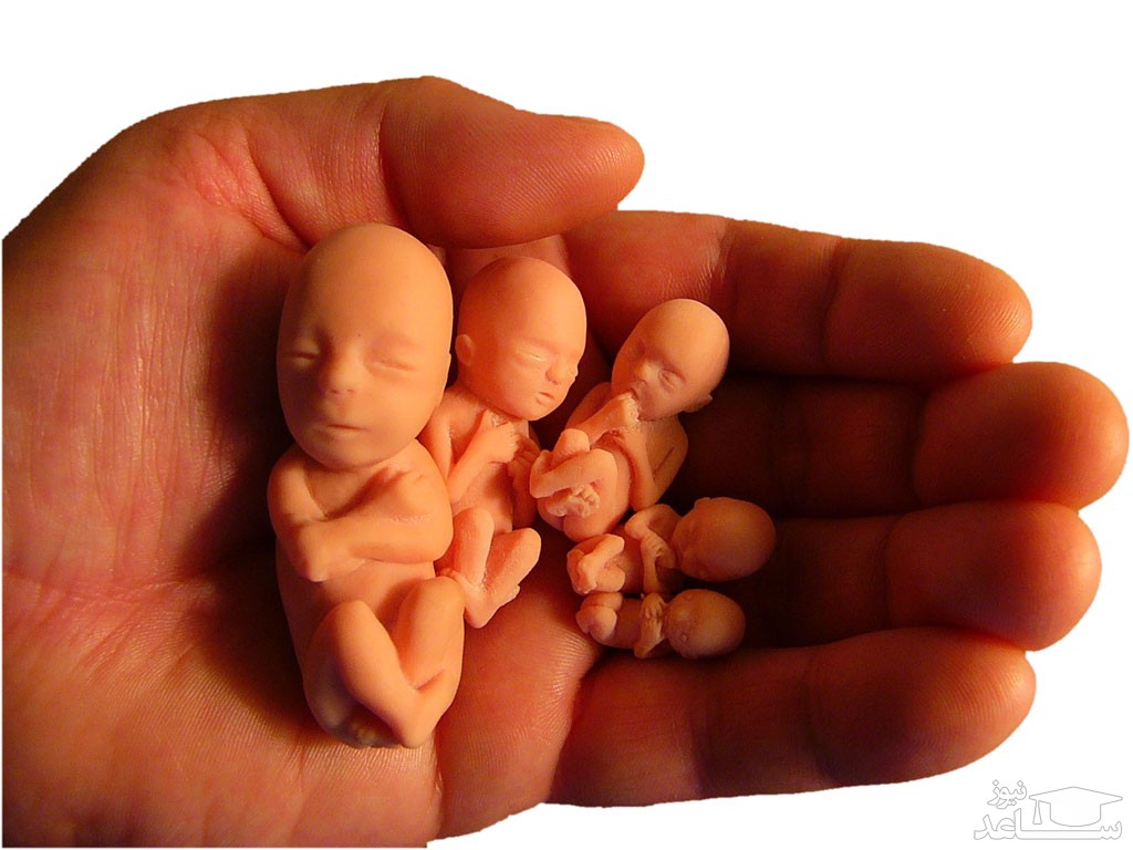 علائم و نشانه های سقط و مردن جنین در شکم
