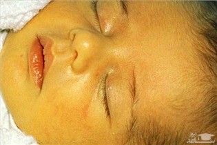 زردی در نوزادان از عوارض زایمان سزارین