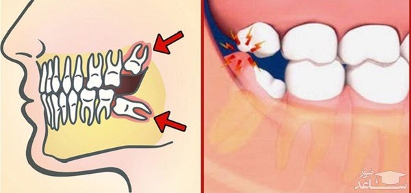 آیا کشیدن یا جراحی دندان عقل ضروری می باشد؟