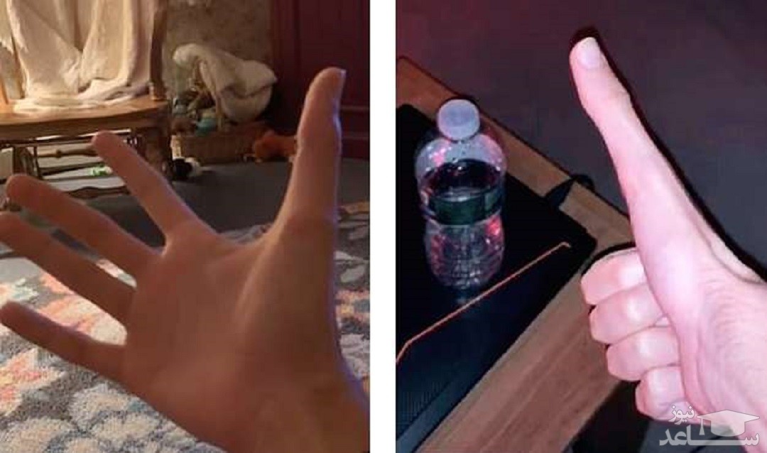 جوانی که به طرز عجیبی می تواند اندازه انگشت شست خود را تغییر دهد