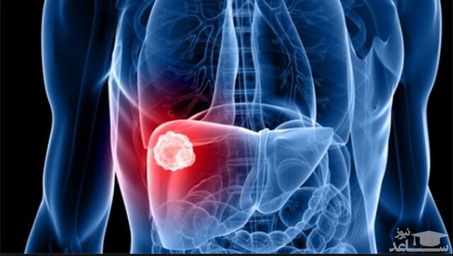 علائم ابتلا به  هپاتیت حاد را بشناسید