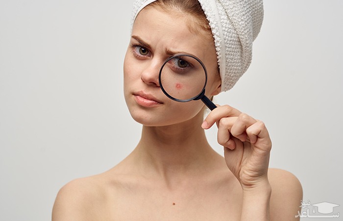 روش های طبیعی درمان جوش های هورمونی