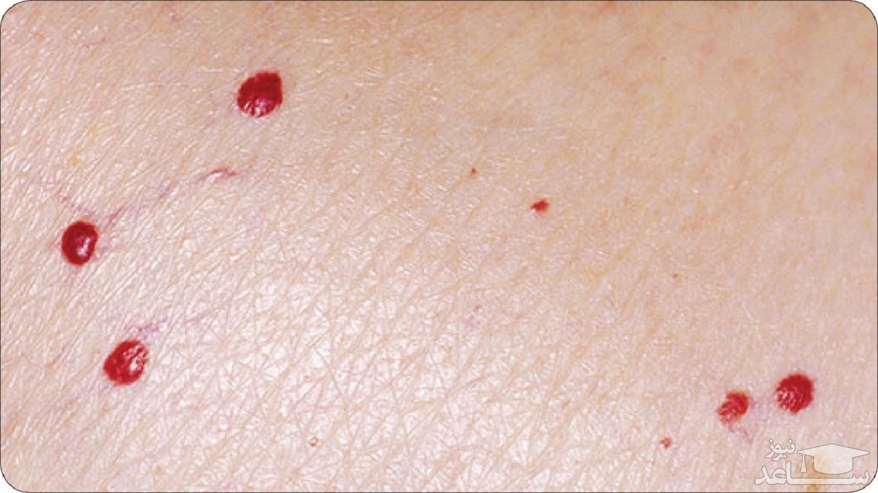 خال قرمز یا آنژیوم گیلاسی چیست؟