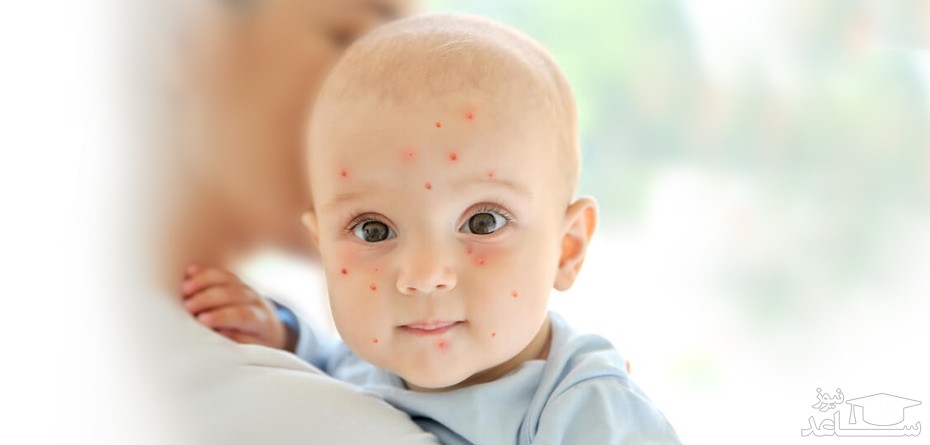 علایم و نشانه های آبله مرغان در کودکان و نوزادان و روش های درمان