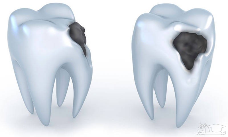 نحوه ی پیشگیری از دندان ‌درد با راهکار های آسان