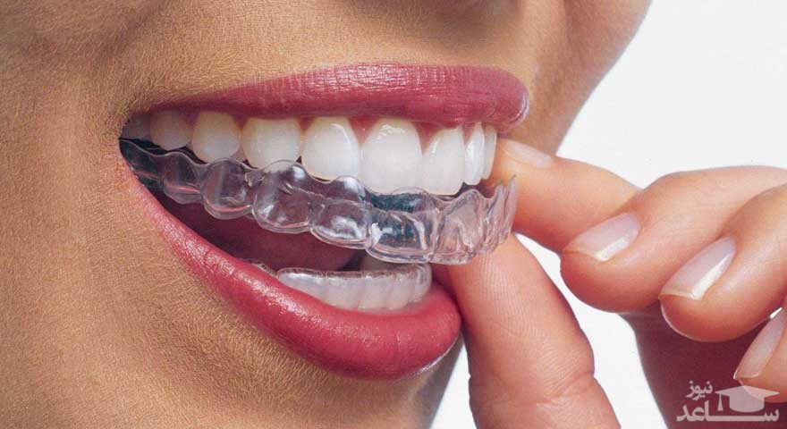 لق شدن دندان در اورتودنسی