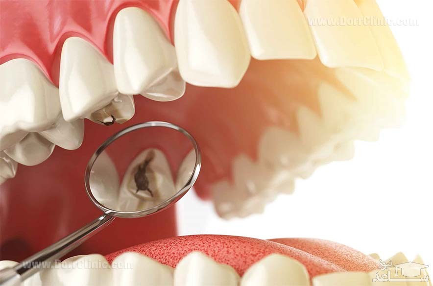 6 نوع از شکستگی دندان که باید فوری درمان شوند!