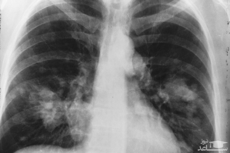 میزان، تاثیرات و مکانیزم اثر داروی زالکوری