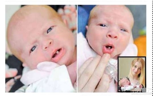 (عکس) نوزادی که با یک دندان متولد شد!