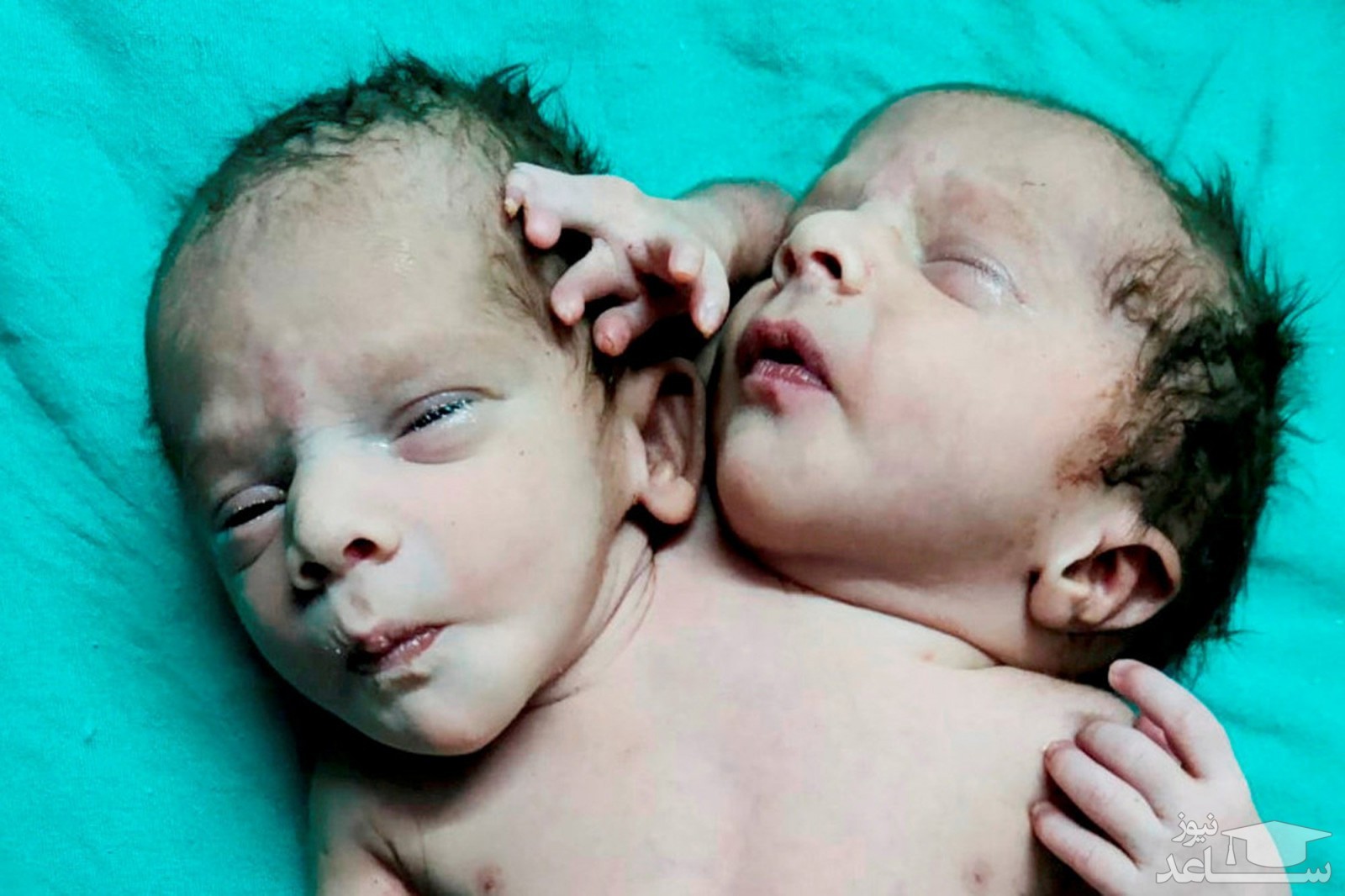 تولد نوزادی عجیب با دو سر و ۳ دست در هند +عکس