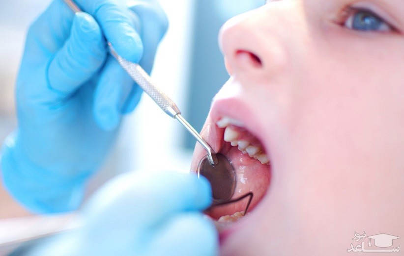 عصب کشی دندان شیری چگونه انجام می‌شود؟
