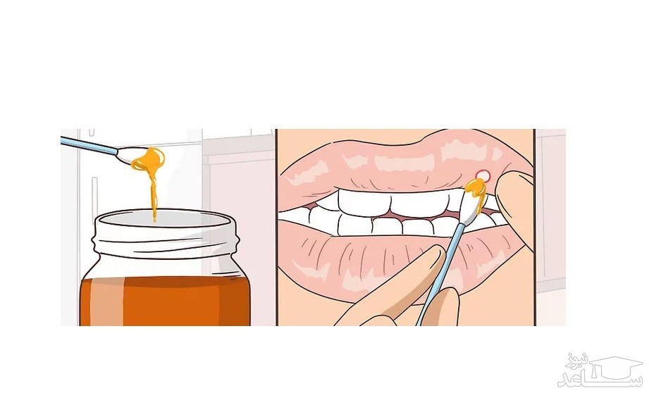 درمان آفت دهان با کمک عسل