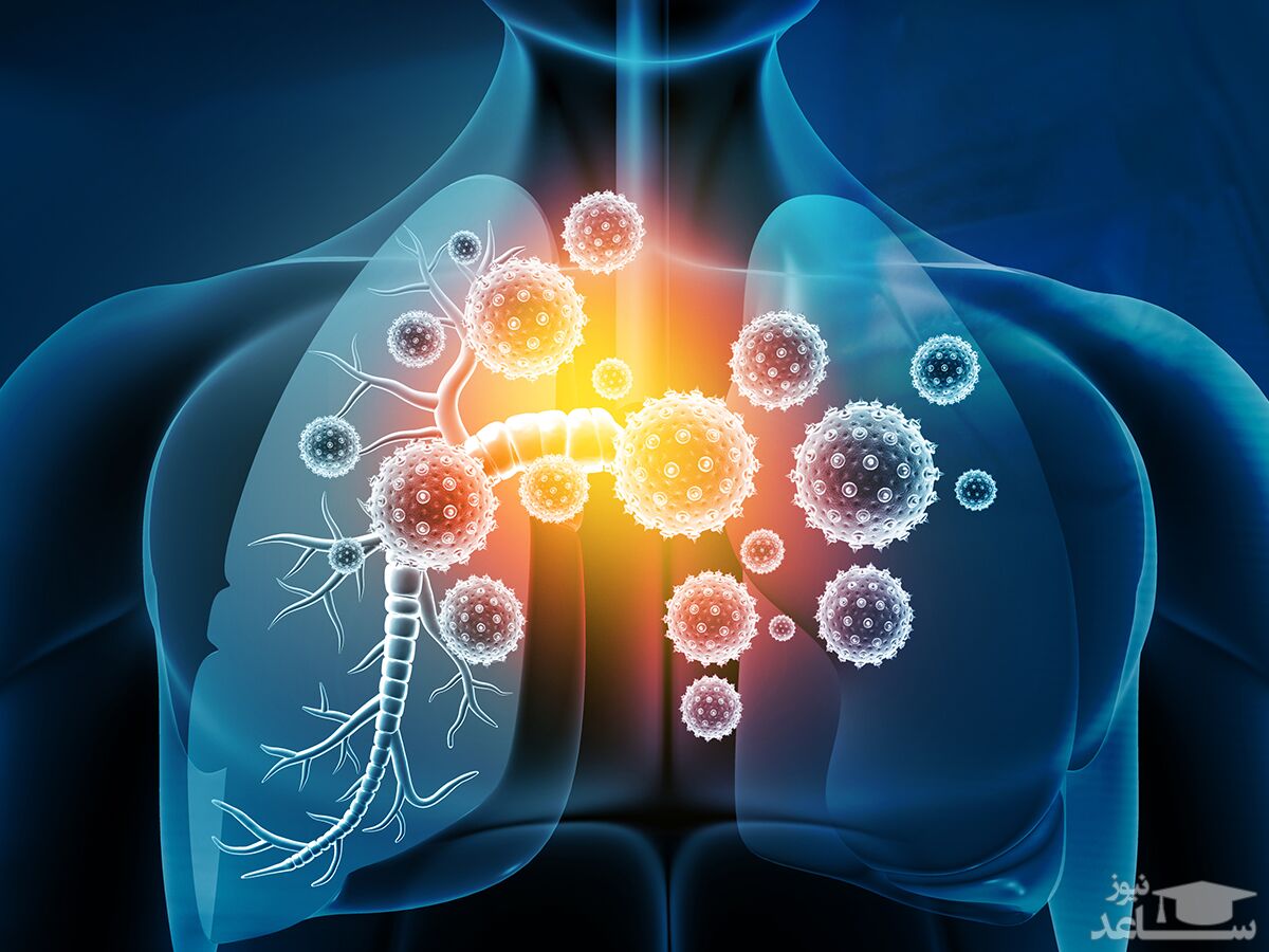 علائم درگیری ریه در مبتلایانِ کرونا