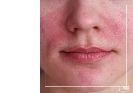 قرمزی و التهاب پوستی