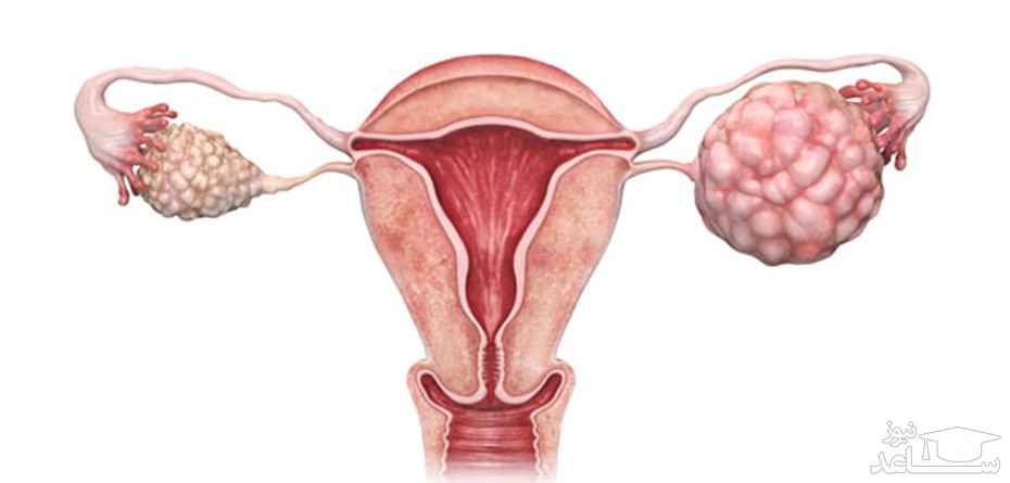 شرایط بارداری در زنان مبتلا به سرطان‌های تخمدان، رحم و دهانه رحم