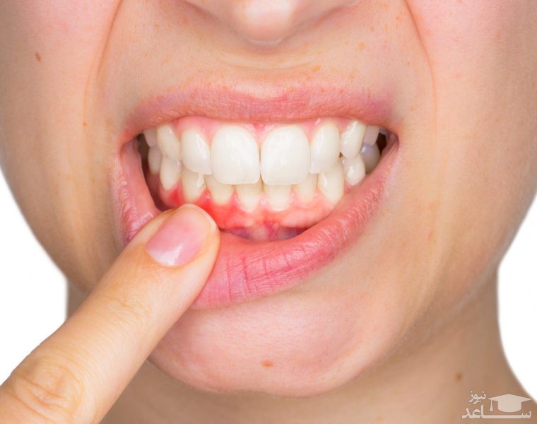 علل عفونت و آبسه دندان و راههای درمان آن