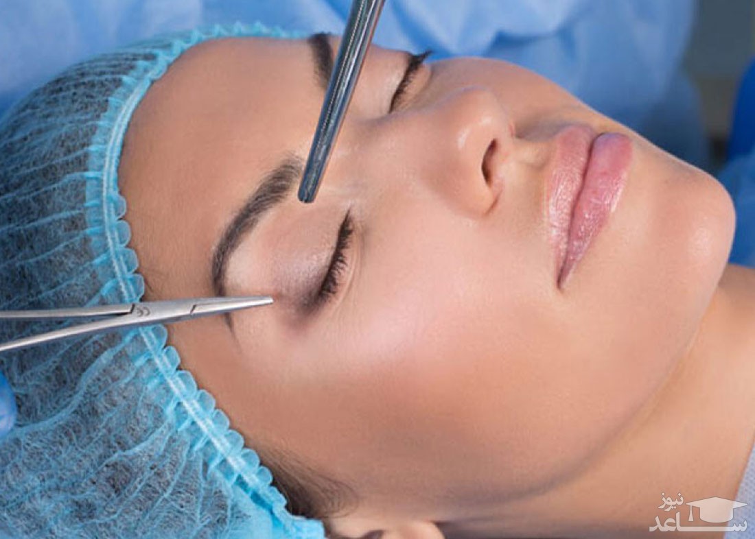 تاثیر شگفت انگیز بلفاروپلاستی بر زیبایی افراد