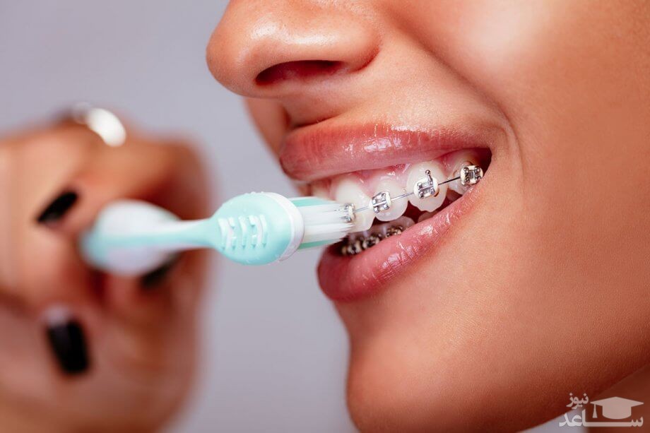سفید کردن دندان پس از ارتودنسی به روش کلینیکی