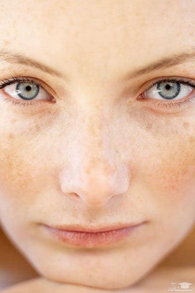 علت بروز لکه های پوستی در دوران بارداری و روش های درمان