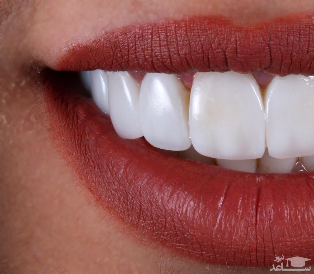 در مورد تغییر رنگ کامپوزیت دندان چه می دانید؟