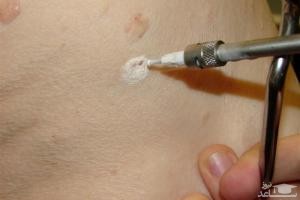 راه های درمان و از بین بردن زگیل تناسلی