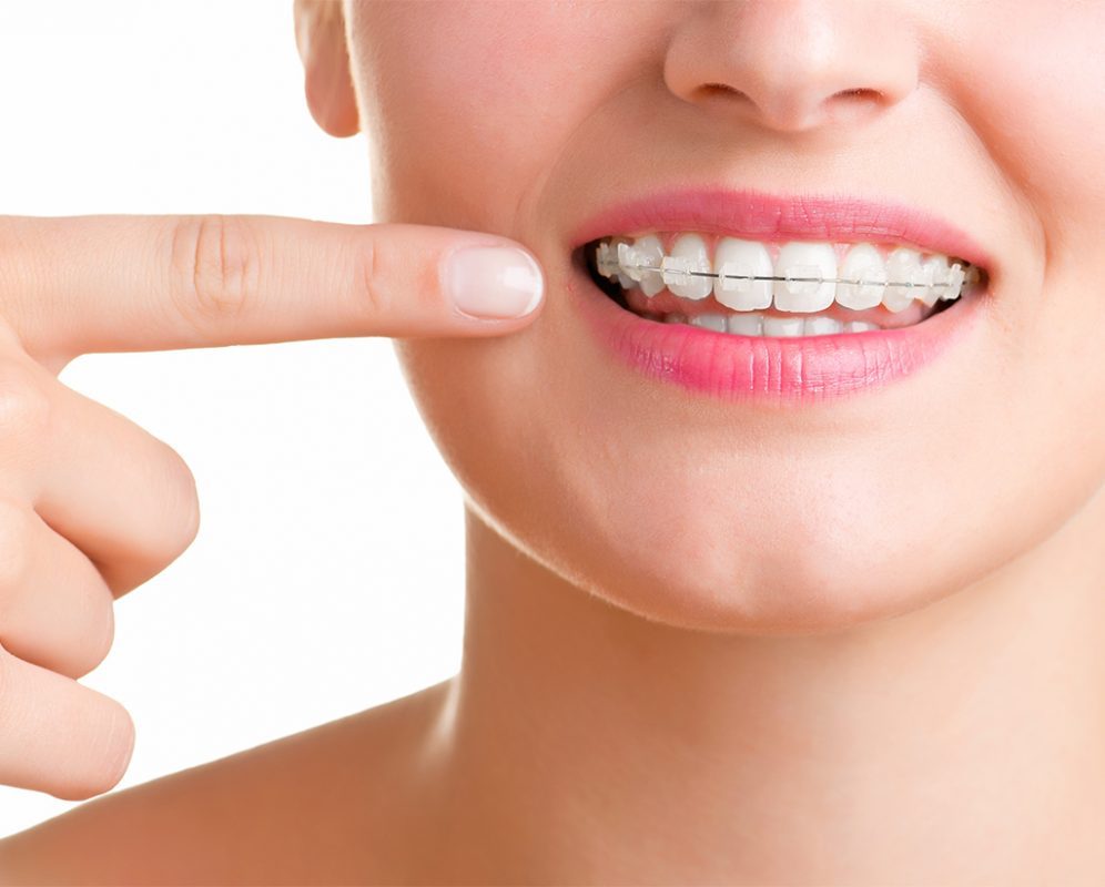 بدون وجود هر گونه سیم روی دندان ها، می توان آنها را مرتب نمود!