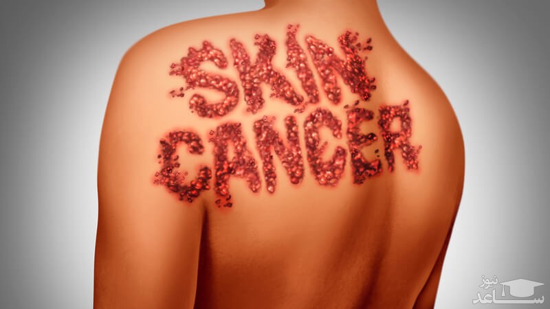علائم سرطان پوست چیست
