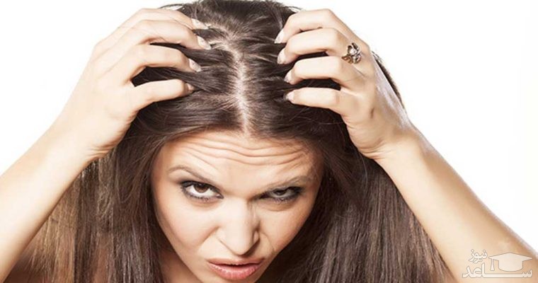 درمان شوره سر به روش های طبیعی