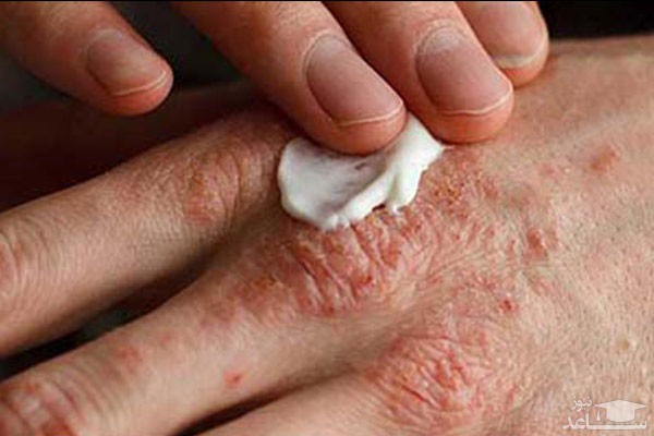 موارد منع مصرف و تداخل دارویی پماد تاکرولیموس