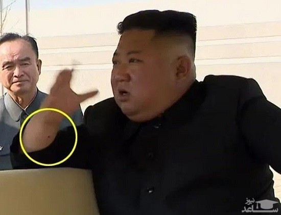 راز جای سوزن روی دست رهبر کره‌شمالی چیست؟
