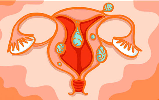 خطرات و عوارض فیبروم در دوران بارداری