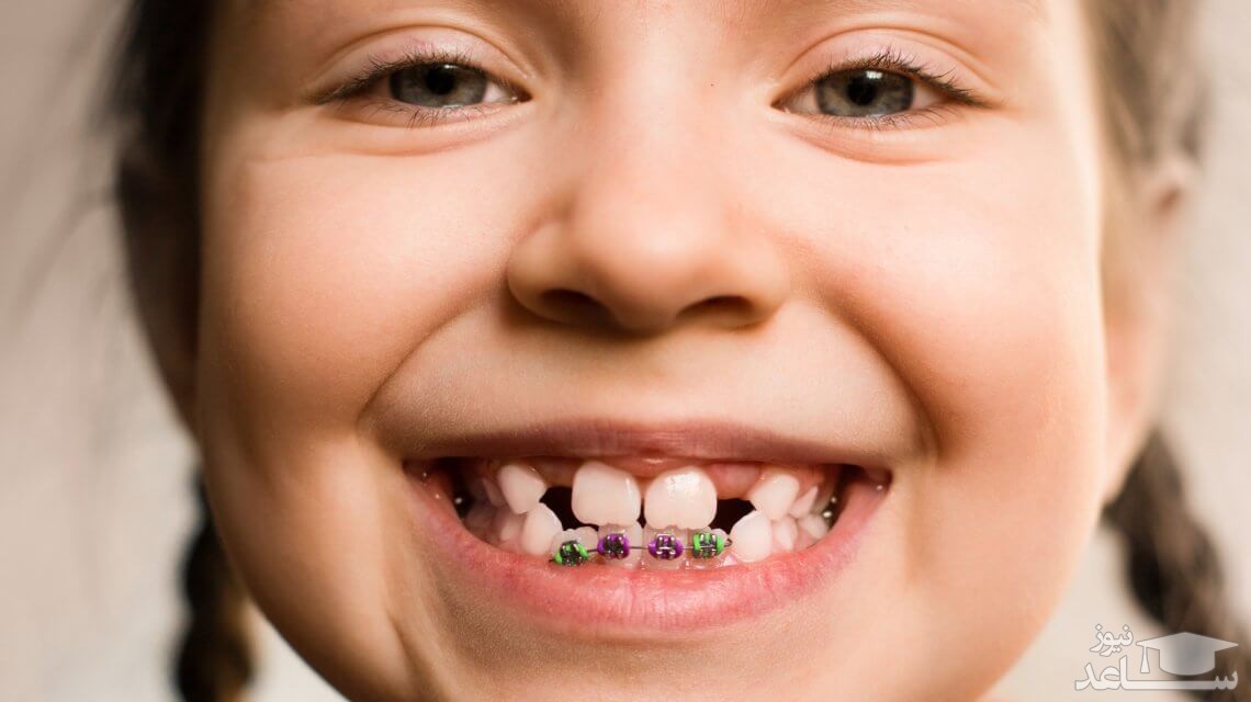 دلایل نامرتب بودن دندان ها