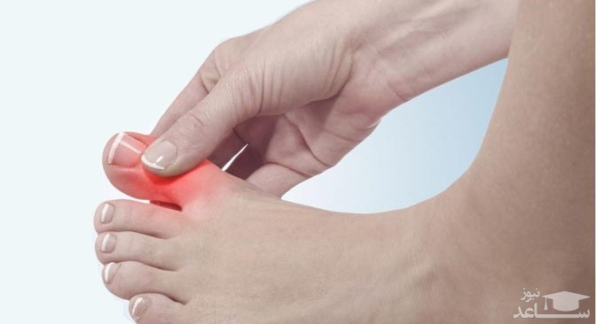 درمان خانگی عفونت فرو رفتن ناخن در گوشت