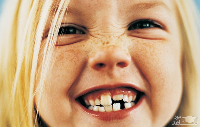 سوالات متداول در مورد دندان اضافی